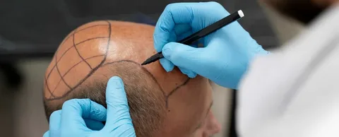Science and Artistry of Modern Hair Transplantation